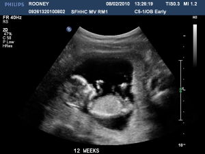 Узи на 12 неделе беременности (фото)