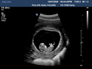 Первый триместр, УЗИ на 11-12 неделе беременности (фото)