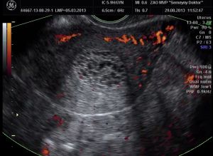 Фото снимок с УЗ-аппарата внутренней слизистой оболочки тела матки (эндометрия)