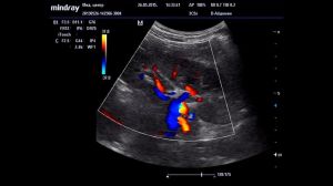 Дуплексный и триплексный режим визуализации сосудов и артерий